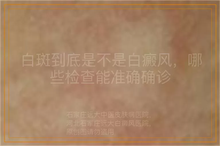 白斑到底是不是白癜风，哪些检查能准确确诊