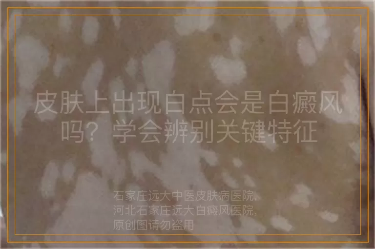 皮肤上出现白点会是白癜风吗？学会辨别关键特征