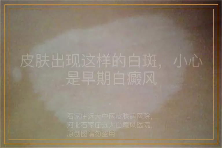 皮肤出现这样的白斑，小心是早期白癜风