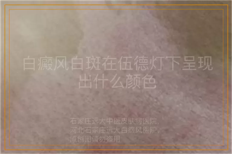 白癜风白斑在伍德灯下呈现出什么颜色