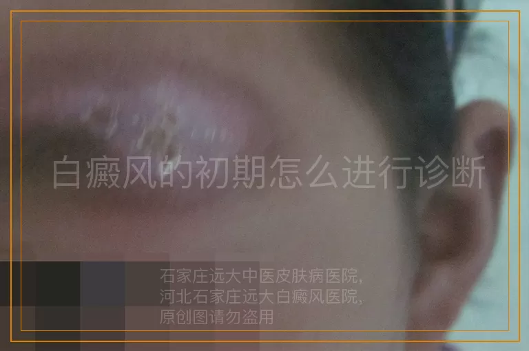 白癜风的初期怎么进行诊断