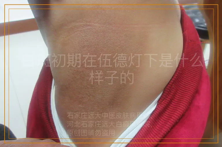 白斑初期在伍德灯下是什么样子的
