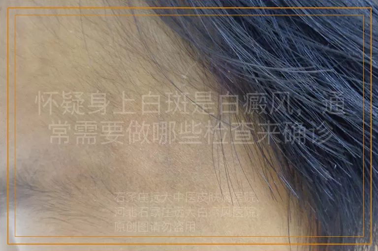 怀疑身上白斑是白癜风，通常需要做哪些检查来确诊