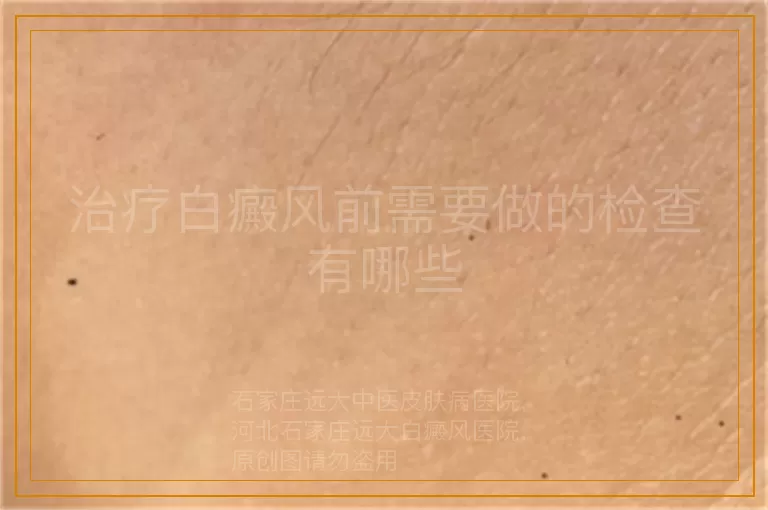 治疗白癜风前需要做的检查有哪些
