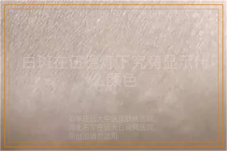 白斑在伍德灯下究竟显示什么颜色