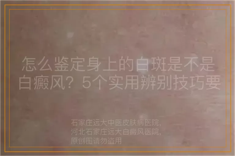 怎么鉴定身上的白斑是不是白癜风？5个实用辨别技巧要记牢