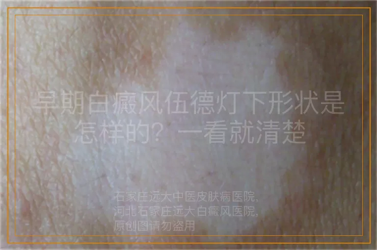 早期白癜风伍德灯下形状是怎样的？一看就清楚
