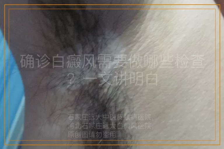 确诊白癜风需要做哪些检查？一文讲明白