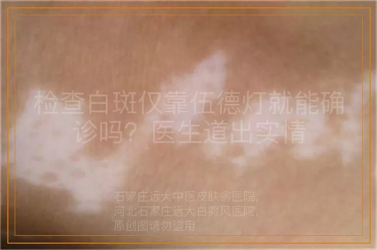 检查白斑仅靠伍德灯就能确诊吗？医生道出实情