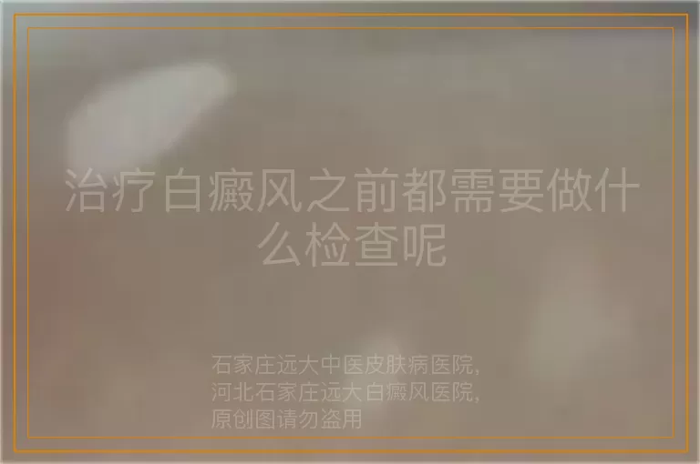 治疗白癜风之前都需要做什么检查呢