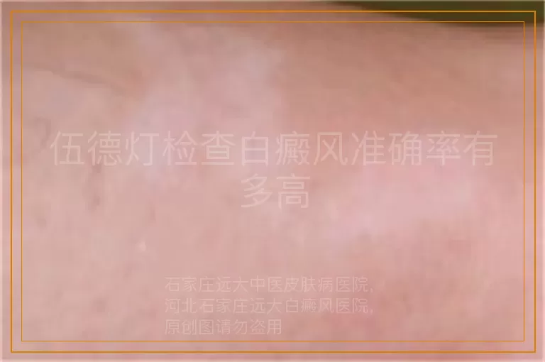 伍德灯检查白癜风准确率有多高