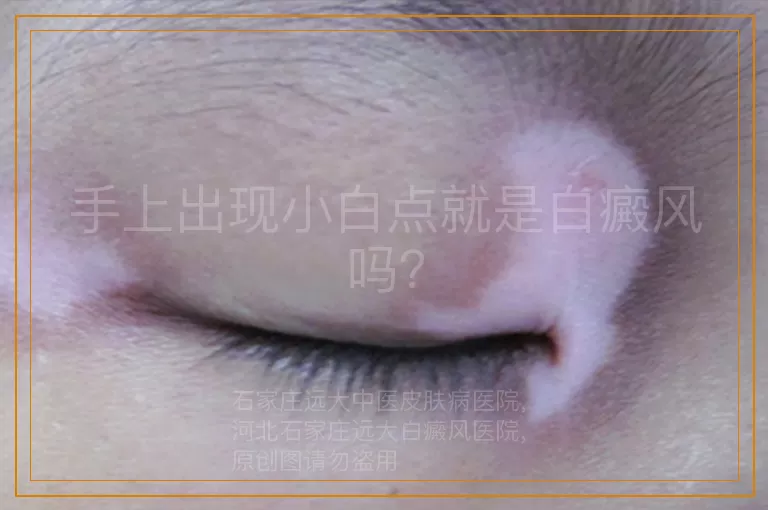 手上出现小白点就是白癜风吗？
