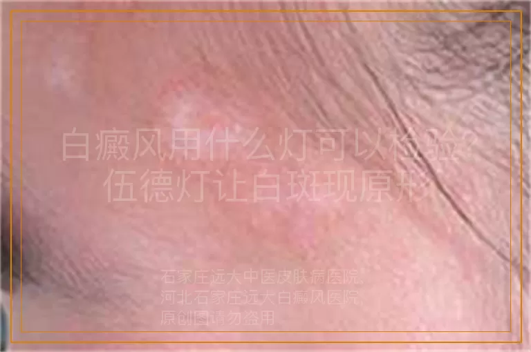 白癜风用什么灯可以检验？伍德灯让白斑现原形