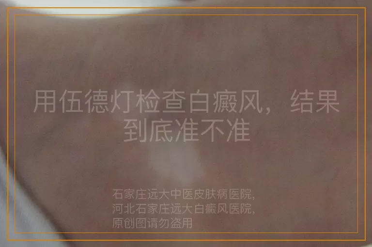 用伍德灯检查白癜风，结果到底准不准