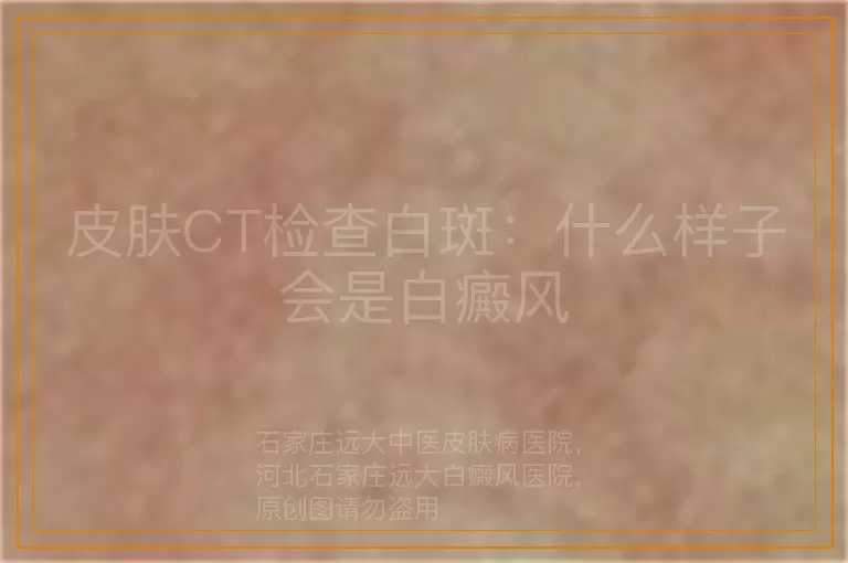 皮肤CT检查白斑：什么样子会是白癜风