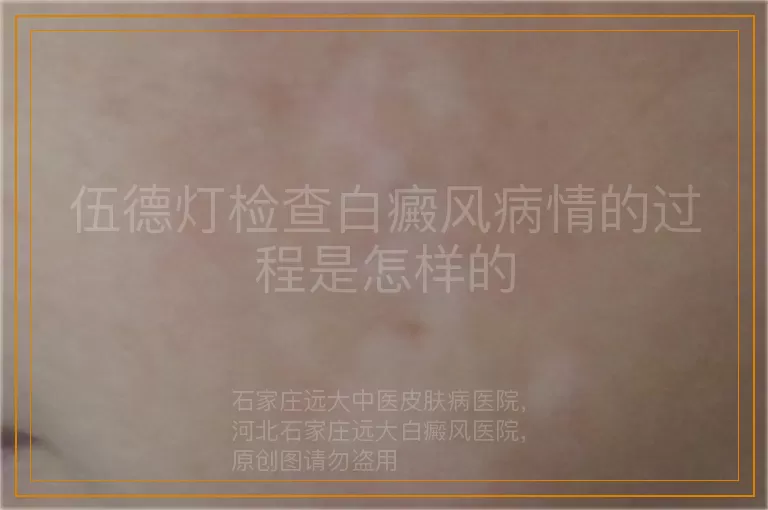 伍德灯检查白癜风病情的过程是怎样的