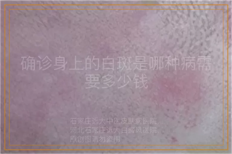 确诊身上的白斑是哪种病需要多少钱