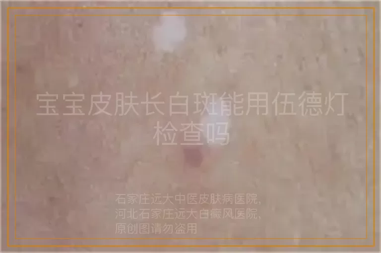 宝宝皮肤长白斑能用伍德灯检查吗