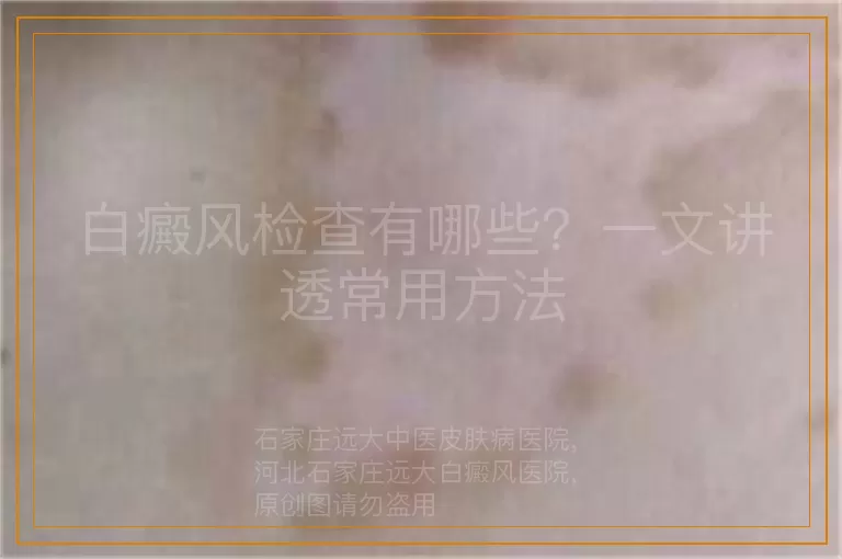 白癜风检查有哪些？一文讲透常用方法