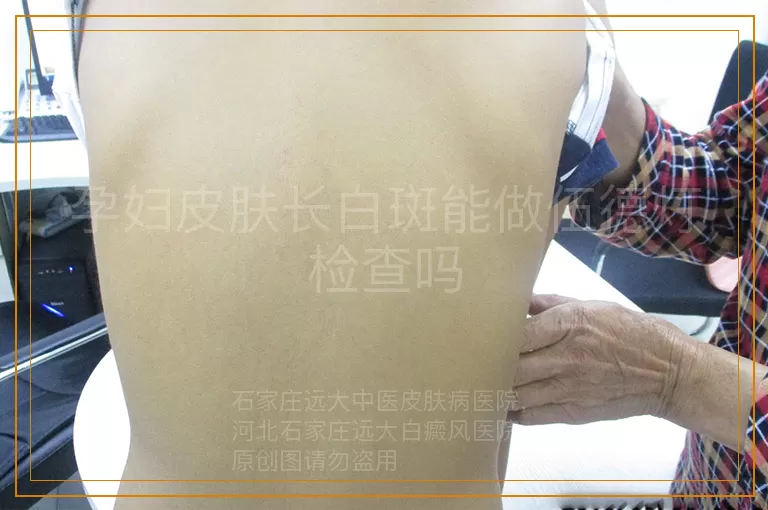 孕妇皮肤长白斑能做伍德灯检查吗