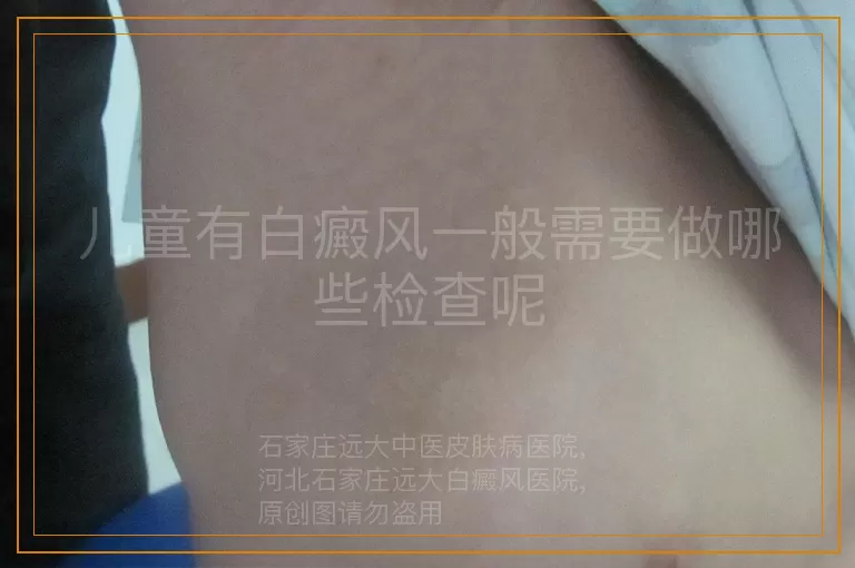 儿童有白癜风一般需要做哪些检查呢
