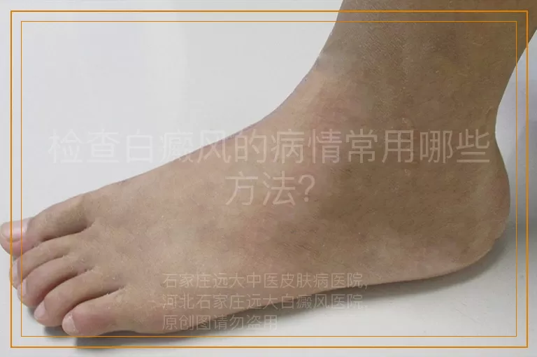 检查白癜风的病情常用哪些方法？