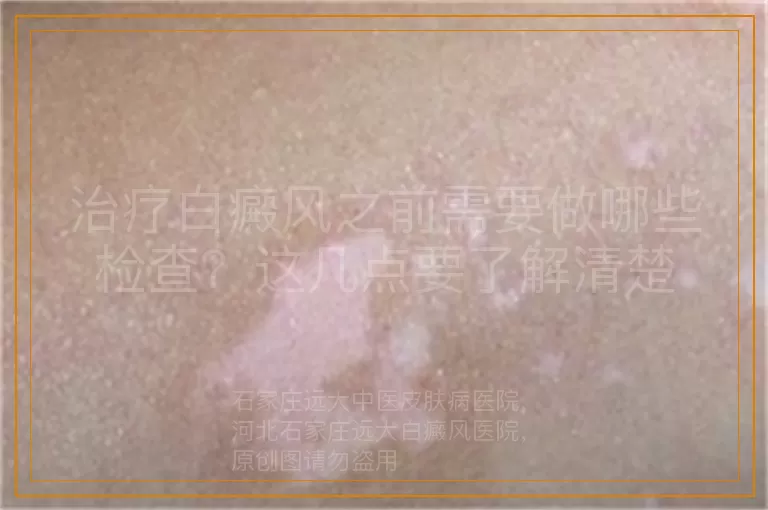 治疗白癜风之前需要做哪些检查？这几点要了解清楚