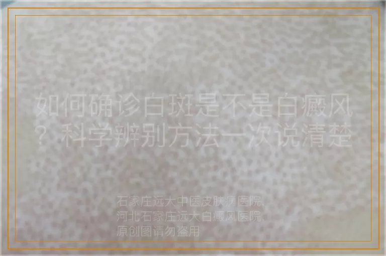 如何确诊白斑是不是白癜风？科学辨别方法一次说清楚