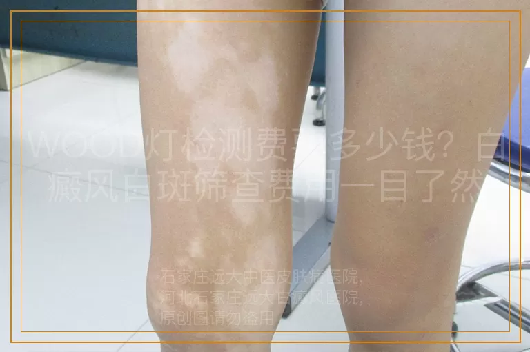 WOOD灯检测费要多少钱？白癜风白斑筛查费用一目了然
