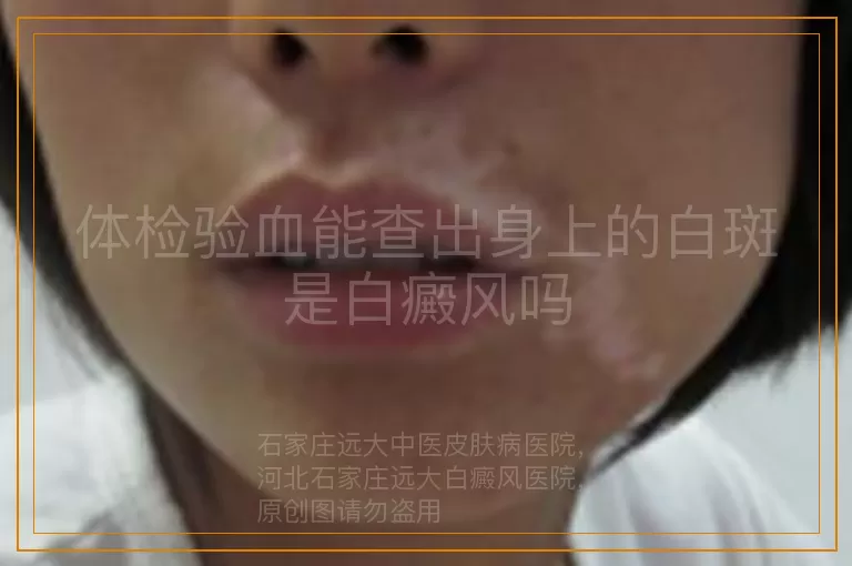 体检验血能查出身上的白斑是白癜风吗