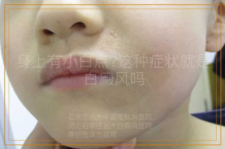 身上有小白点?这种症状就是白癜风吗