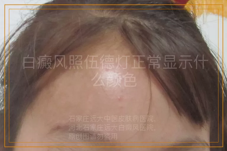 白癜风照伍德灯正常显示什么颜色