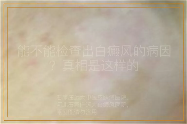 能不能检查出白癜风的病因？真相是这样的