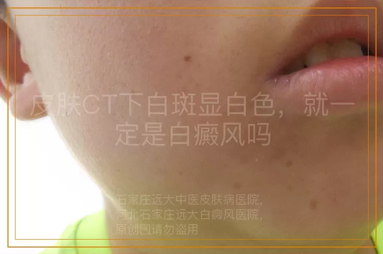 皮肤CT下白斑显白色，就一定是白癜风吗