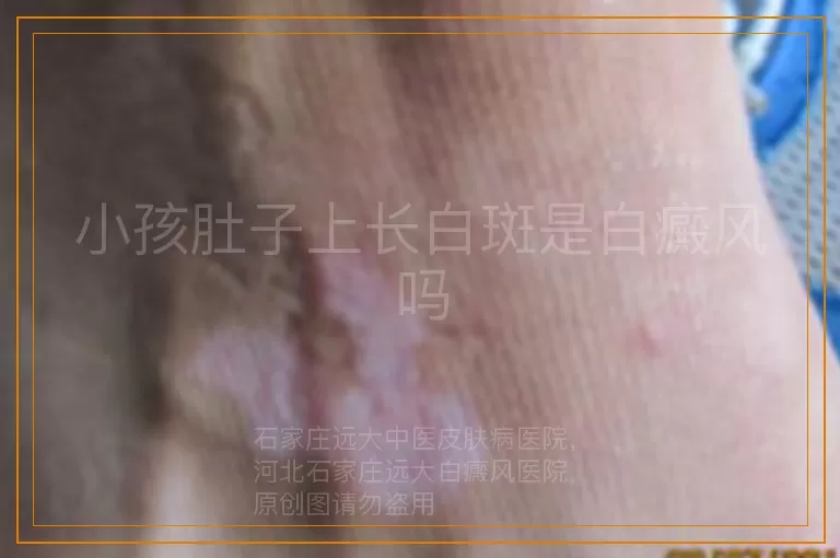 小孩肚子上长白斑是白癜风吗