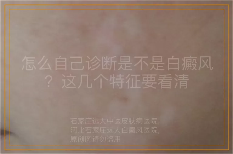 怎么自己诊断是不是白癜风？这几个特征要看清