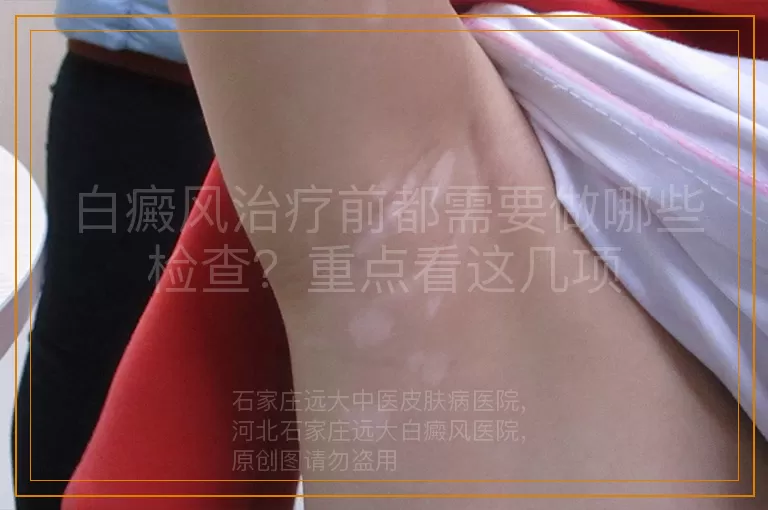 白癜风治疗前都需要做哪些检查？重点看这几项