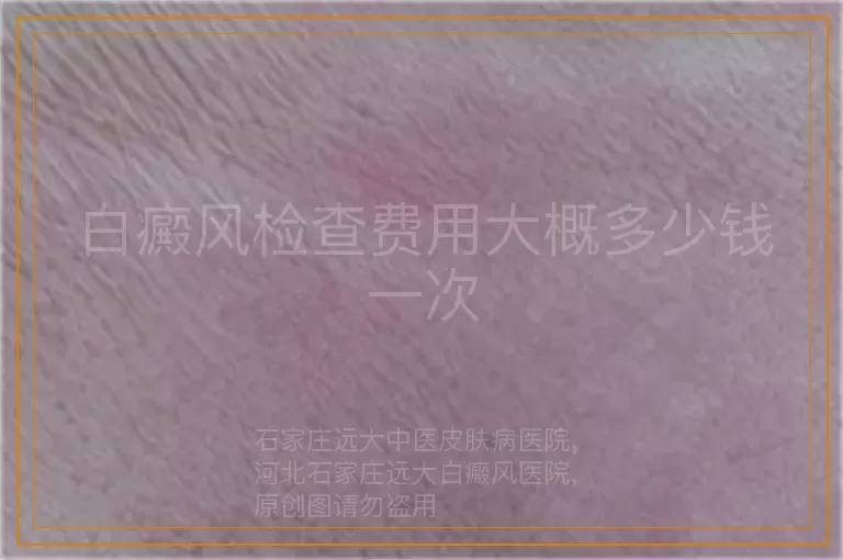 白癜风检查费用大概多少钱一次
