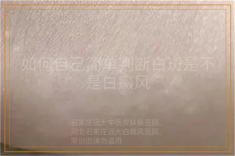如何自己简单判断白斑是不是白癜风