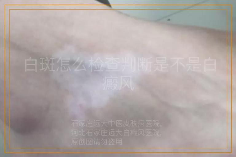 白斑怎么检查判断是不是白癜风