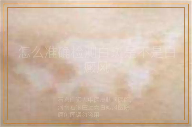 怎么准确检测白斑是不是白癜风
