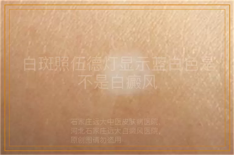 白斑照伍德灯显示蓝白色是不是白癜风