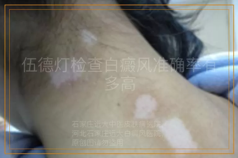 伍德灯检查白癜风准确率有多高