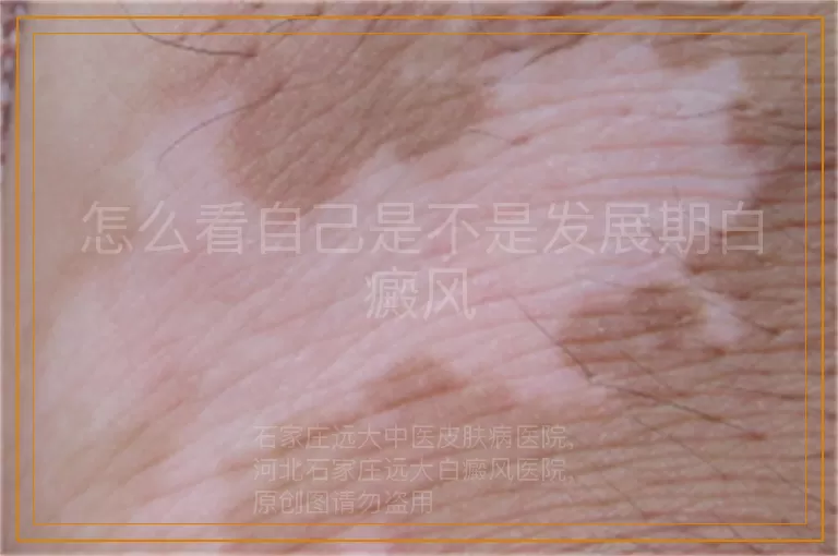 怎么看自己是不是发展期白癜风