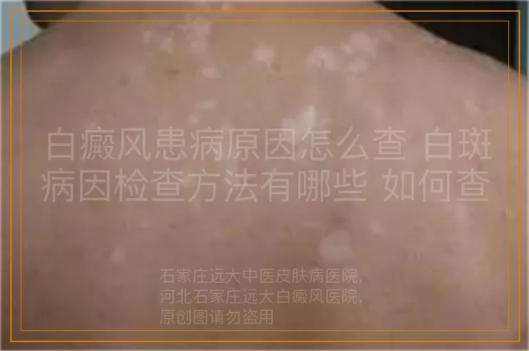 白癜风患病原因怎么查 白斑病因检查方法有哪些 如何查出白癜风发病原因