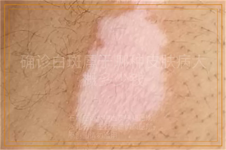确诊白斑属于哪种皮肤病大概多少钱