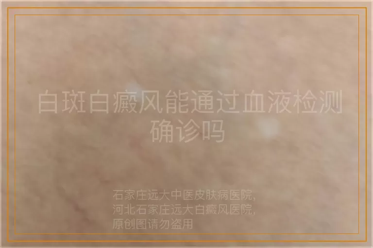 白斑白癜风能通过血液检测确诊吗