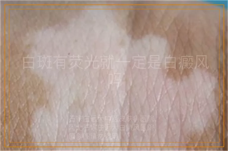 白斑有荧光就一定是白癜风吗