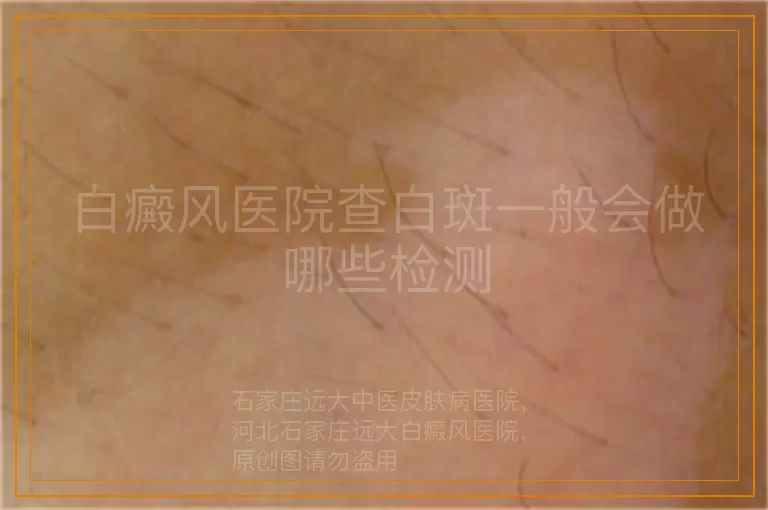 白癜风医院查白斑一般会做哪些检测