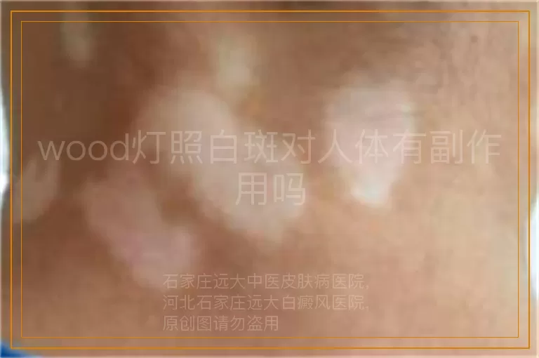 wood灯照白斑对人体有副作用吗